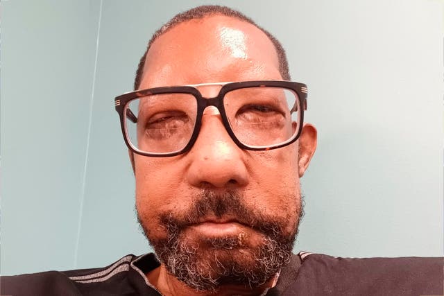 <p>One of the patients in the study is Robert Chelsea. Chelsea, 68, became the first Black patient, and the oldest, to receive a full face transplant at Boston’s Brigham and Women’s Hospital in July 2019. A resident of Los Angeles, Chelsea had suffered burns over 60 percent of his body and face after his car was hit by a drunk driver in 2013. His surgery lasted for 16 hours, involving a team of 45 professionals. Reconstruction procedures can last for up to 30 hours, and take months for recovery. The recovery process is physical and mental.</p>